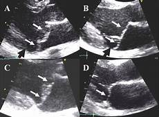 Male Valve