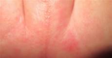 Rash Cream