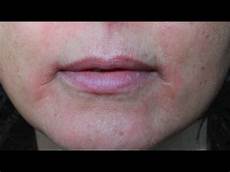 Rash Cream