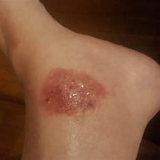 Rash Cream