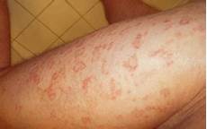 Rash Cream