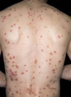Rash Cream
