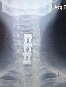 Screws