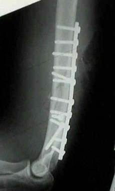 Screws